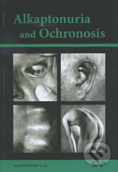 Alkaptonuria and ochronosi