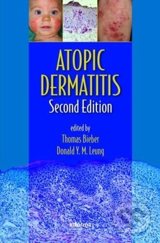Atopic Dermatitis (Second Edition)