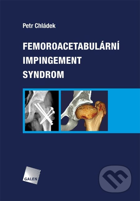 Femoroacetabulární impingement syndrom
