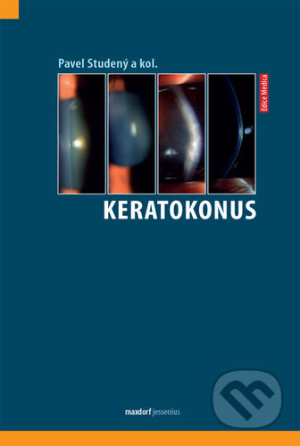 Keratokonus