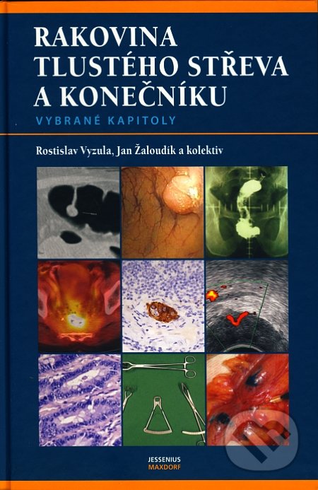 Rakovina tlustého střeva a konečníku