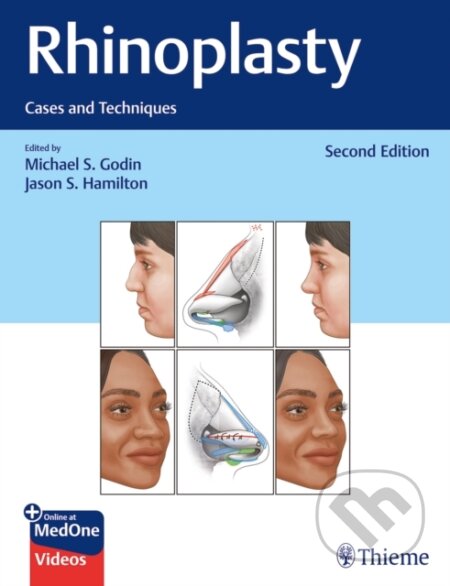 Rhinoplasty (Cases and Techniques)