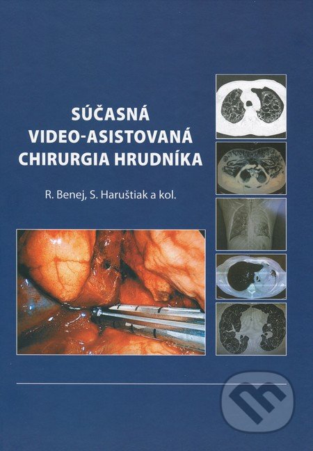 Súčasná video-asistovaná chirurgia hrudníka