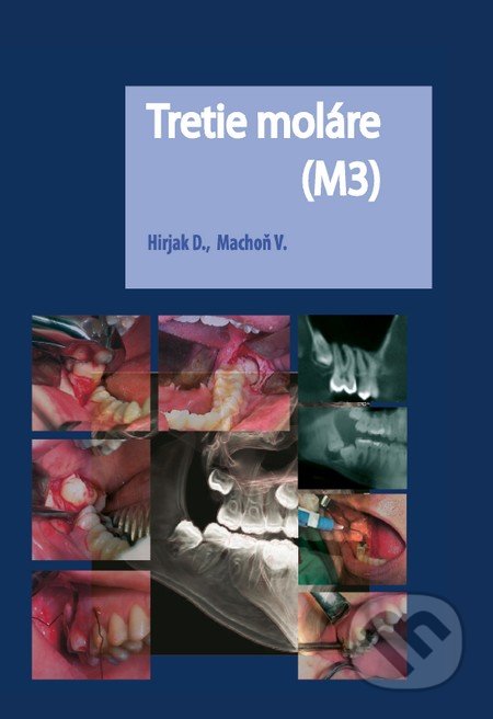 Tretie moláre (M3)