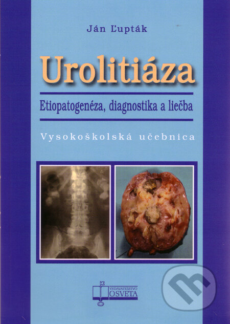 Urolitiáza (Etiopatogenéza, diagnostika a liečba)
